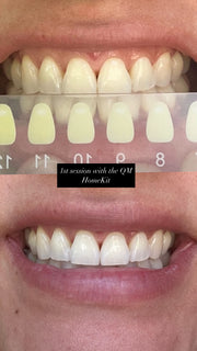 24k Hollywood whitening kit!